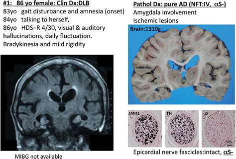End Stage of Emphysema 的图像结果