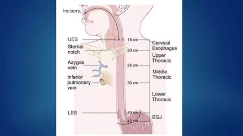 RT in Ca esophagus | PPTX