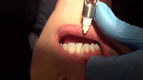 Infiltration Anesthesia Dental Lower 的图像结果