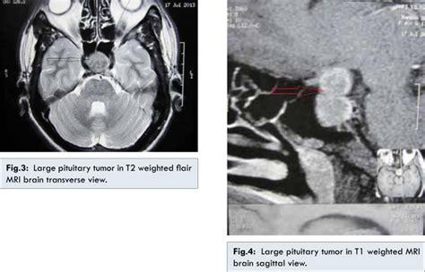 Acromegaly Presenting as Congestive Cardiac Failure