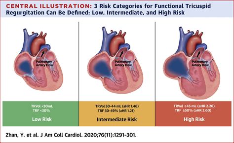 Tricuspid Valve Regurgitation Heart Sound at Hudson Becher blog