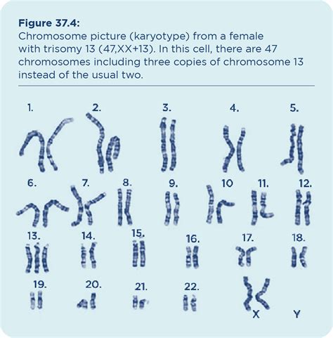 Patau Syndrom Karyotype Karyotype Test Purpose And Steps