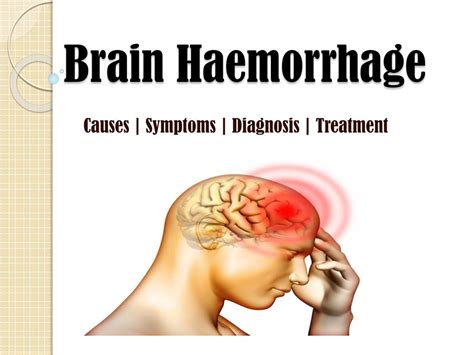 PPT - Brain Hemorrhage (Bleeding): Causes, Symptoms, Treatments PowerPoint Presentation - ID:7565727