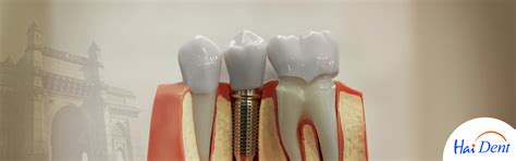 Blog | COST OF DENTAL IMPLANTS IN MUMBAI, Hai Dent