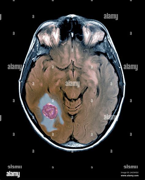 Brain cancer. Coloured magnetic resonance imaging (MRI) scan of a section through the brain of a ...