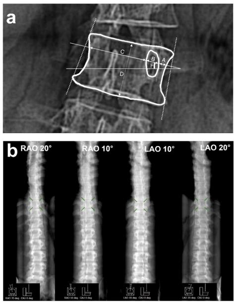 Developing a Spine Internal Rotation Angle Measurement System Based ...