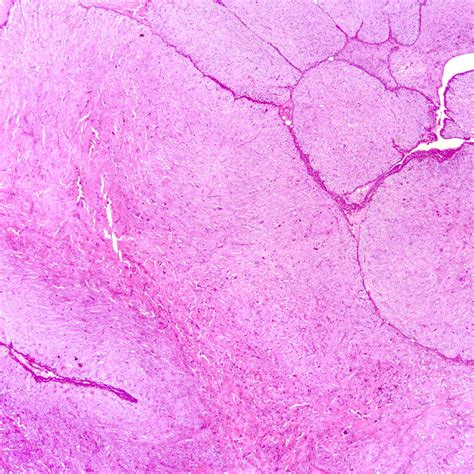 Pathology Outlines - Phyllodes tumor