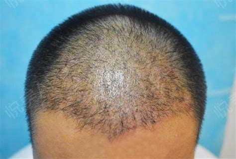 北京世熙整形医院植发科头发种植有哪些特点呢 有后遗症吗_千颜网_您身边的整形管家