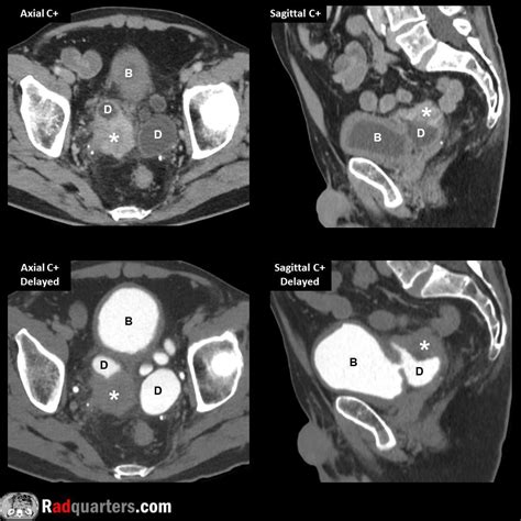 Image result for CT Cystogram vs Urogram
