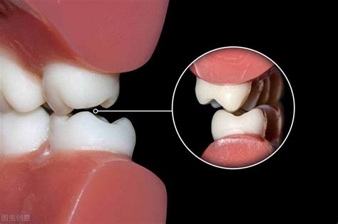 夜间磨牙的原因解答,详解儿童/成人晚上磨牙的治疗方式 - 口腔资讯 - 牙齿矫正网