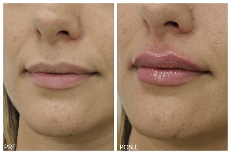 Uvećanje usana hijaluronskim filerima - Estetika dr Jeremić