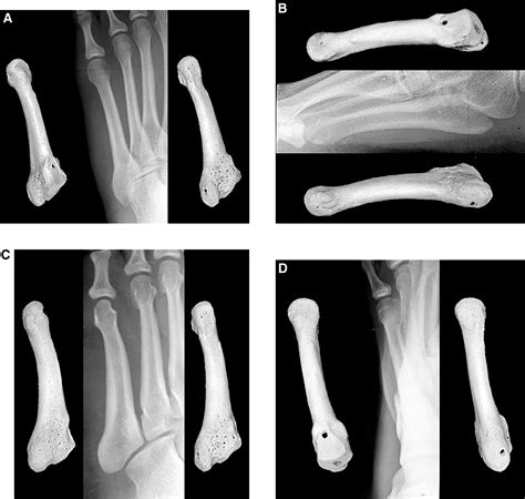 Radiographic Anatomy of the Foot and Ankle—Part 4. The Metatarsals