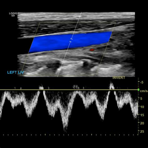 Upper Extremity Venous Doppler – Sonographic Tendencies | Vascular ultrasound, Diagnostic ...