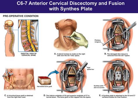 Cervical radiculopathy causes, symptoms, diagnosis & treatment