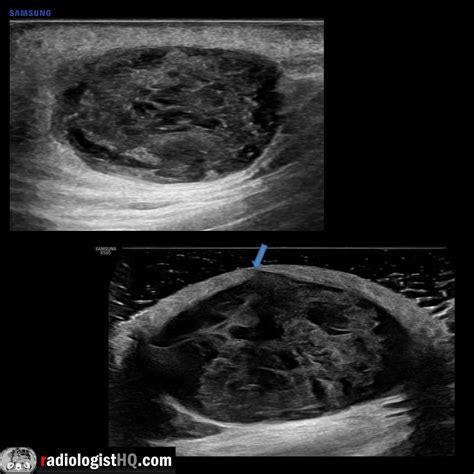 Vaginal Inclusion Cyst