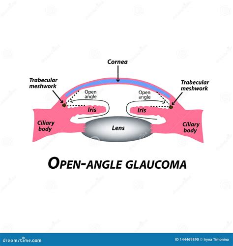 Primary open angle glaucoma signs and symptoms. Primary Open-Angle Glaucoma: The Silent Thief of ...