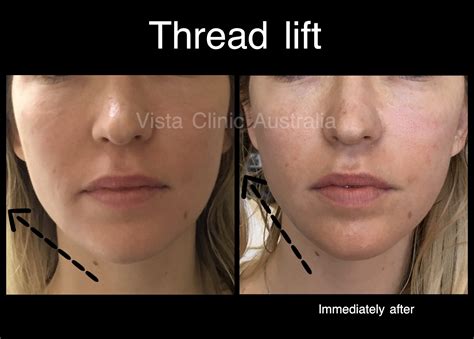 PDO thread lift - Vista Clinic Melbourne Australia