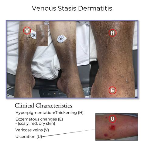 Clinical Pathology Glossary: Venous Stasis Dermatitis (Venous ...