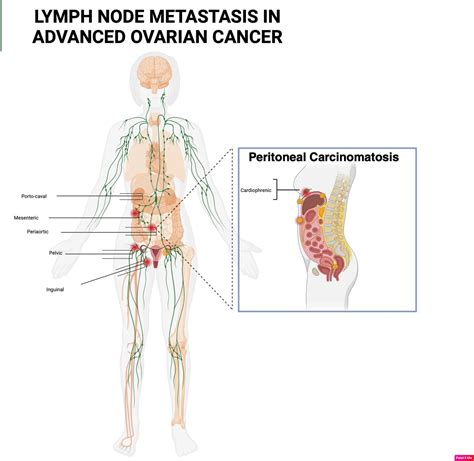 Retroperitoneal Lymph Nodes