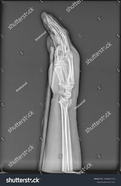 Forearm Xray Showing Distal Radius Ulna Foto Stok 2186827233 | Shutterstock
