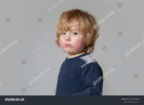 Toddler Boy Lip Lickers Dermatitis Rash Stock Photo 2431979059 | Shutterstock