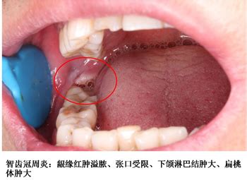 世界口腔健康日｜牙痛不是病，痛起来真要命！ 新闻资讯 -四川大学华西口腔医学院