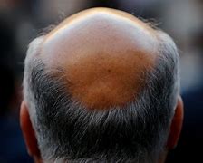 baldness 的图像结果