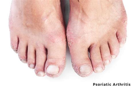 Psoriatic Arthritis | Foot Specialist Toronto | Feet First Clinic