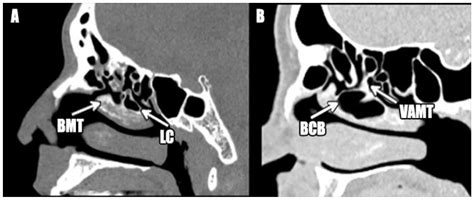 Concha Bullosa Ct Sinus