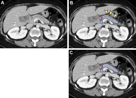 Pancreatic Cancer Detection on CT Scans with Deep Learning: A ...