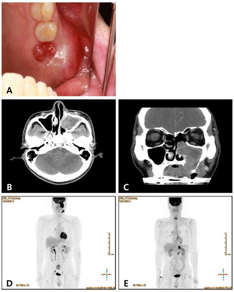 Retention Cyst Of The Maxillary Sinus Image
