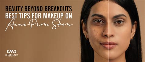Beauty Beyond Breakouts: Best Tips For Makeup On Acne-Prone Skin | Charmacy