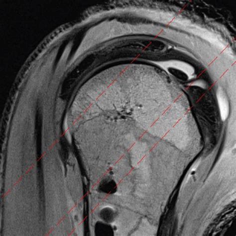Rotator Interval Capsule Is Formed By at Denise Feliciano blog