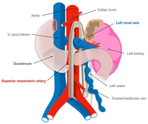 Interventional Management of a Rare Combination of Nutcracker and Wilkie Syndromes