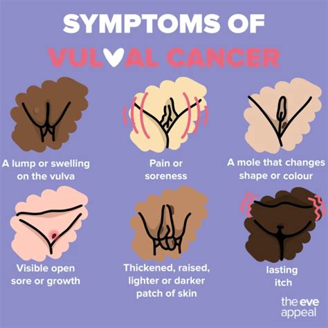 Vulva Cancer « St Andrews House Medical Centre