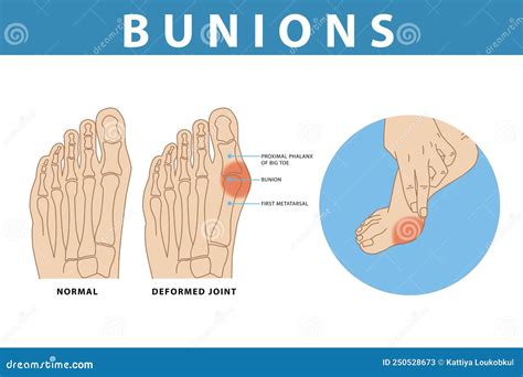 Normal And Bunion Hallux Valgus Foot, Illustration Drawing On White Background Royalty-Free ...