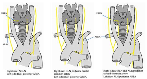 Recurrent Laryngeal Nerve