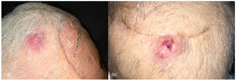 Management of Cutaneous Squamous Cell Carcinoma of the Scalp: The Role of Imaging and ...
