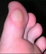 Image result for blisters