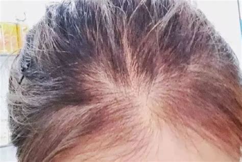 【中医】脱发人群超过2.5亿。你的头发还安全吗？