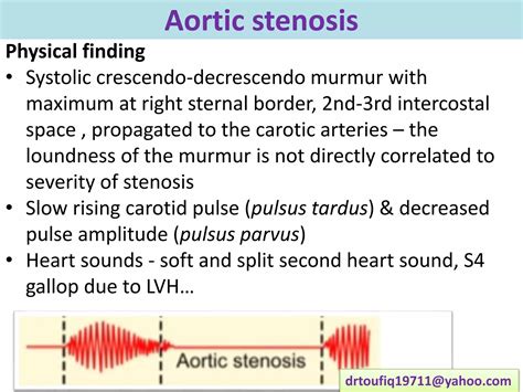 Aortic stenosis for post graduates | PPSX