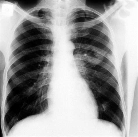 Primary pulmonary TB: plain chest x-ray | Wellcome Collection