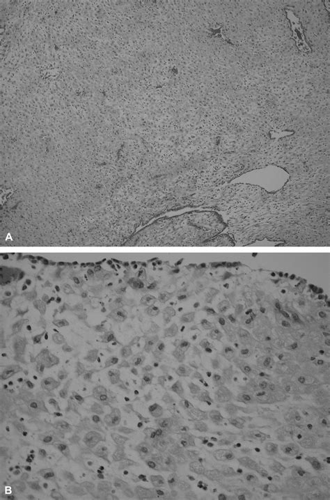 Decidual Cast in a Girl Receiving Depot Medroxyprogesterone Acetate—A Case Report - Journal of ...