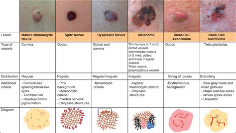 Nodular Basal Cell Carcinoma Of The Eyelid