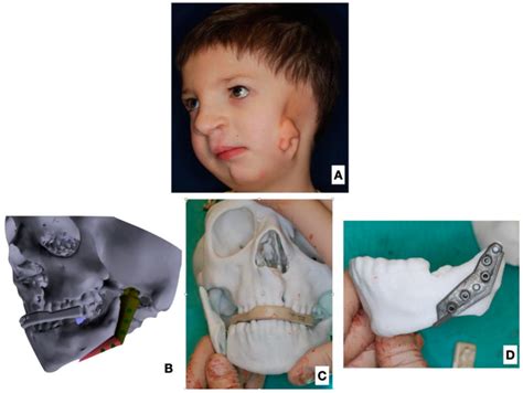 Use of a Fibula Free Flap for Mandibular Reconstruction in Severe Craniofacial Microsomia in ...