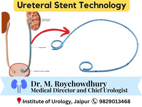 Ureteroscopy Stent How Ureteral Stent Is Reshaping The Future Of