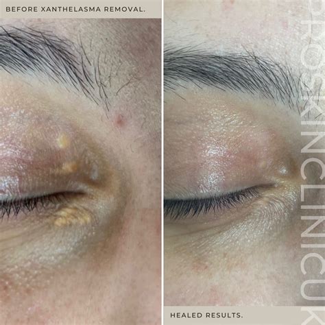Xantelasma Xanthelasma Removal London Dermasurge Clinic