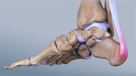 What You Need to Know About Achilles Tendonitis – Frederick Foot And Ankle