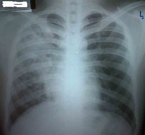 TB PARU, jenis TB yang paling sering Klik paru