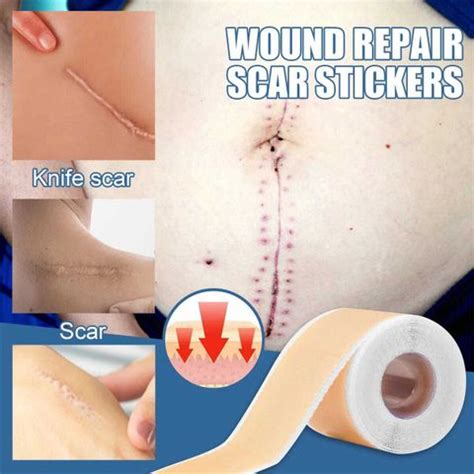 Dr. NAvadiya Silicone Scar Sheet Reduce Hypertrophic & Keloid Scars ...